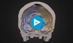 3d-skull-tumor-mashable