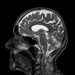 mri-brain-pixa